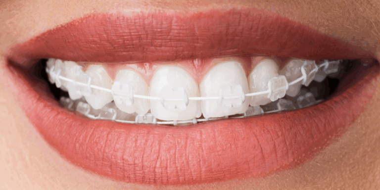 alternativas a los brackets tradicionales