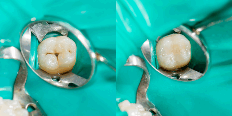 restauración dental