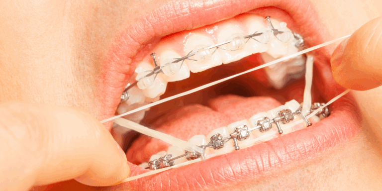 proceso colocacion ortodoncia